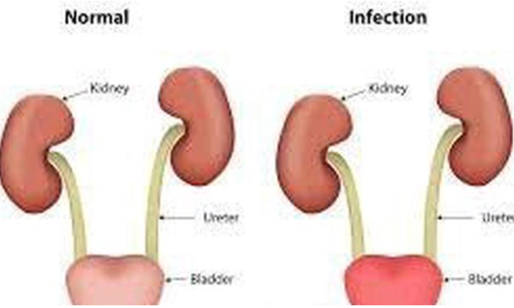 Danger Of Urinary Tract Disease; Avoid These 8 Things If You Want To Live Longer.