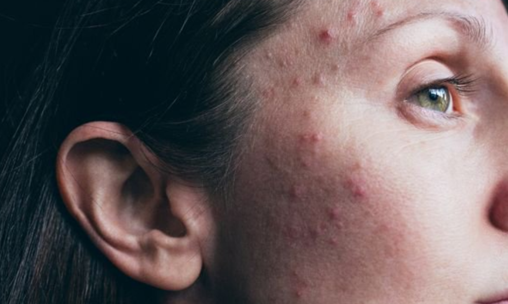 Doctor warns of common foods and drinks that secretly harm your skin