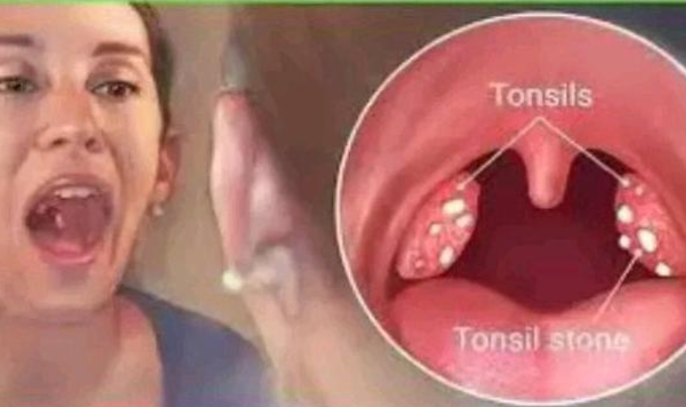 How To Cure Tonsillitis In 4 Hours, Fast And Easy