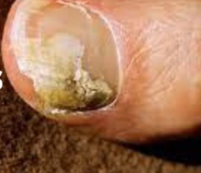 How exactly did you cure your own toe nail fungus