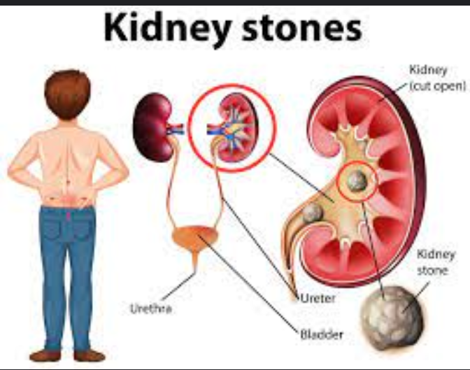 Kidney Stones Kill Faster, Start Eating More Of These Foods To prevent it