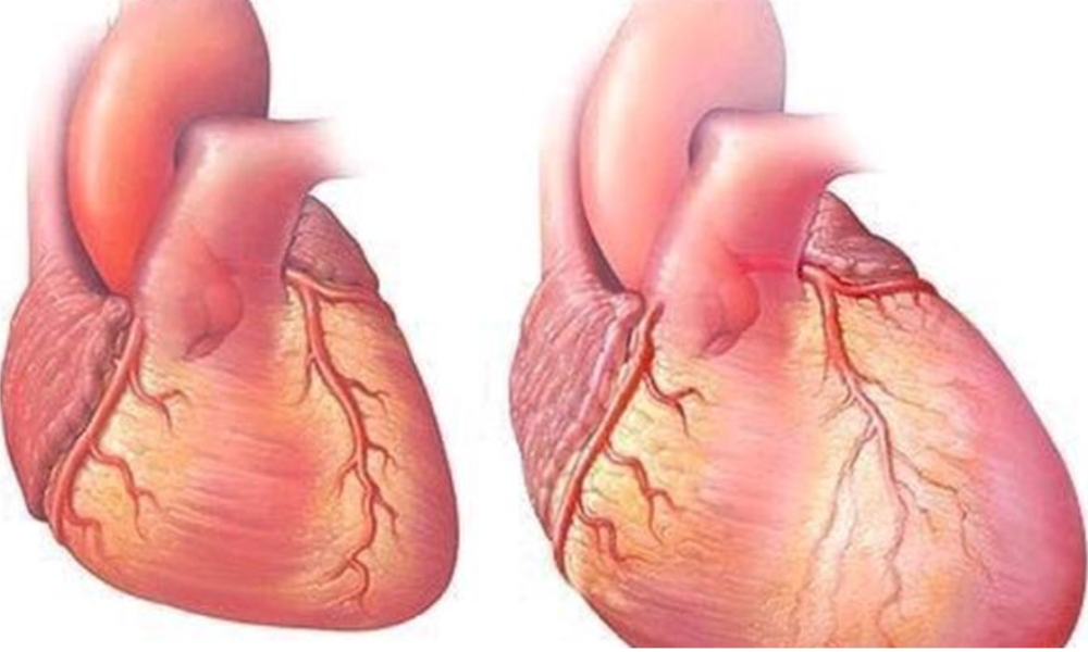 Protect Your Heart From Heart Failure By Avoiding Too Much Intake Of These Three Things