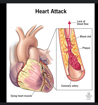 Seven Early Signs You Are Prone to Heart Attack