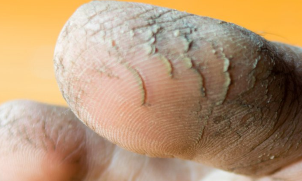 The cracks in your feet might be telling you something