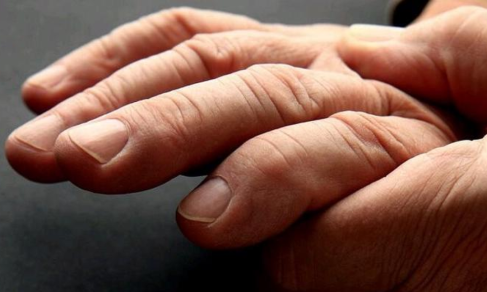 Three signs in your hands that could mean you have serious health issues including cancer