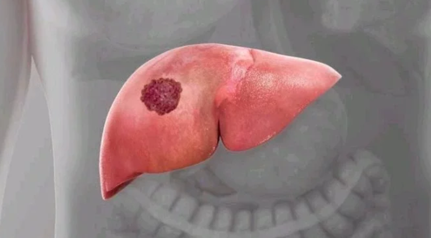 WARNINGS: Everyone Should Avoid Liver Cancer By Staying Away From These 4 Things