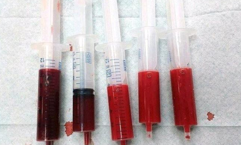 What To Know About HIV and Blood Type-O