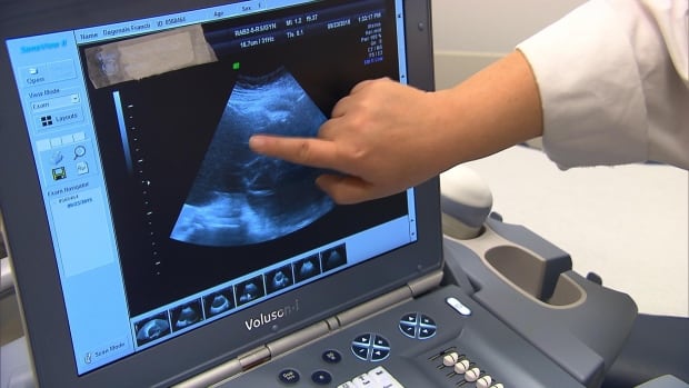 Ultrasound staffing ‘critically low’ in Nova Scotia, union says