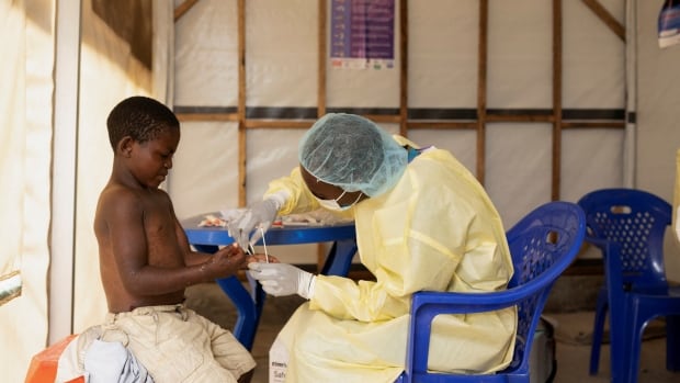 Mpox is a global emergency again. How deadly is it? What are 'clades'? What you need to know