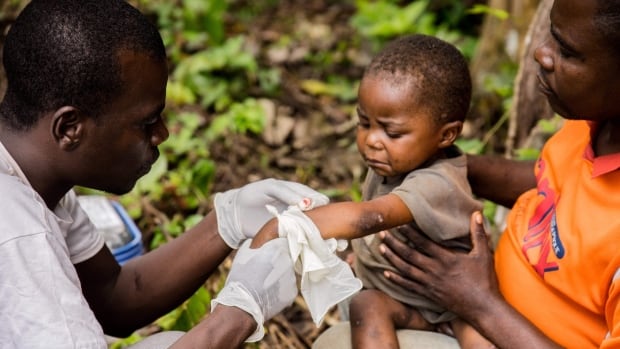 Growing mpox ‘crisis’ prompts Africa to declare first-ever public health emergency