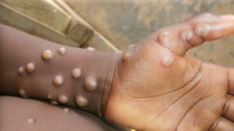 First Mpox vaccine administered in Africa