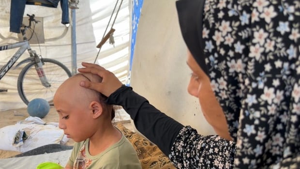 The stress of life in Gaza has taken most of this little girl’s hair