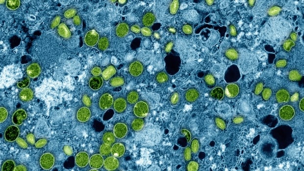 Manitoba detects 1st confirmed case of recently identified mpox strain in Canada