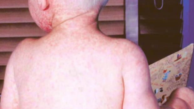 AHS issues public alert after measles case confirmed in Calgary